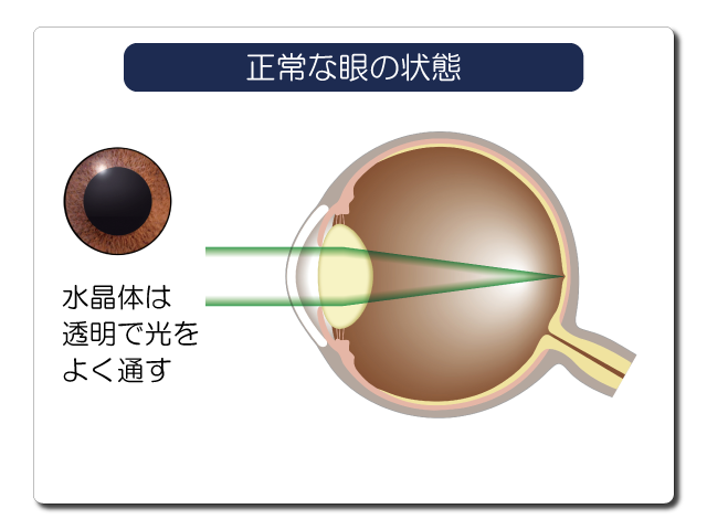 正常な眼