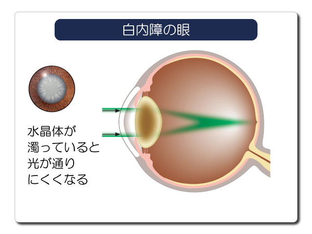 白内障の眼